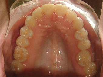Invisalign treatment for crowded teeth with a cross-bite after 881776