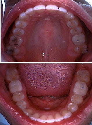 Invisalign after 109370
