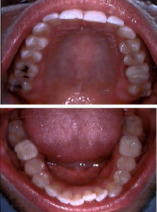 Invisalign before 109370
