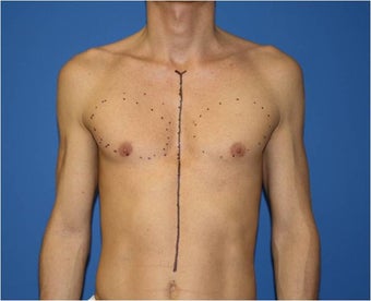 Pectoral Augmentation, Pec Implants before 665735