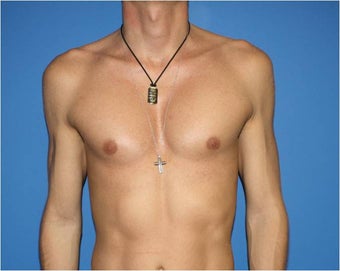 Pectoral Augmentation, Pec Implants after 665735