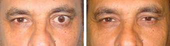 Prosthetic Eye before 1178942