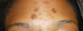 Exfoliating Facial for Pigmented Acne Scars before 110223