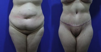 32 Year Old Treated for Abdominal Apron & Sagging Buttocks before 1109111