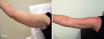 Mesotherapy to upper arms before 6514