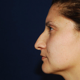 Rhinoplasty before 1357431