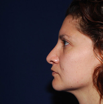 Rhinoplasty after 1357431