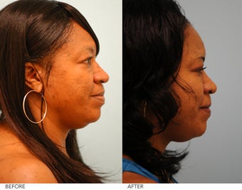 Lip Reduction after 229187