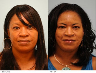 Lip Reduction before 229187