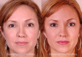 Revision Rhinoplasty before 681864