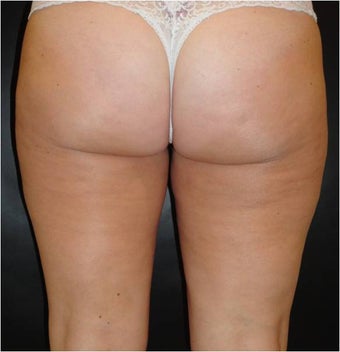 SmartLipo MPX after 686139