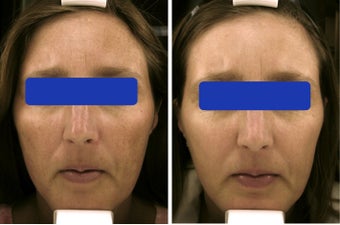 Female treated for Age Spots before 911854