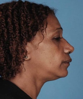 Rhinoplasty 854066