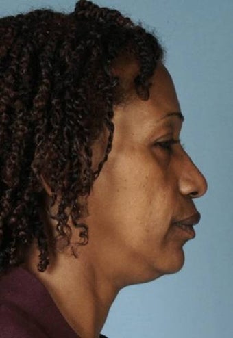 Rhinoplasty 854066