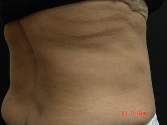 Coolsculpting after 501140