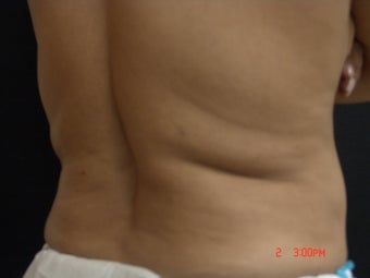 Coolsculpting before 501140