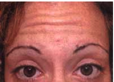 Botox Injections before 1223303