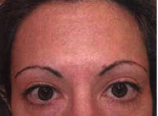 Botox Injections after 1223303