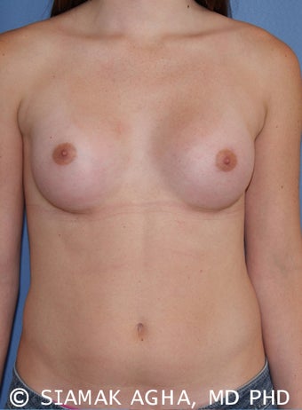 Transgender Breast Augmentation after 673498