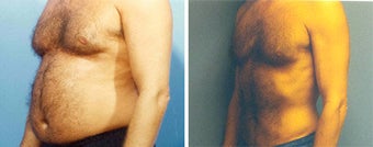 Liposuction before 278755