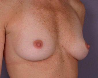 Breast Augmentation before 281419