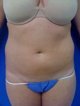 Laser Lipo 333234