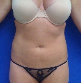 Laser Lipo 333234
