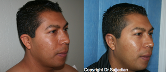 Ear Surgery before 1245311