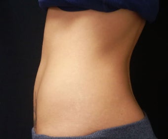 Coolsculpting 1143840