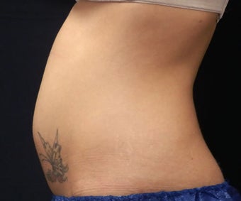 Coolsculpting 1143840