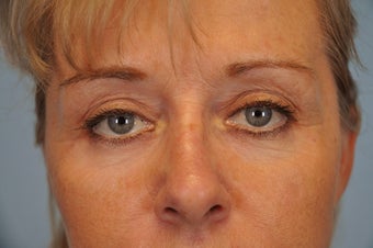 Hetter Peel on lower eyelids. after 857419