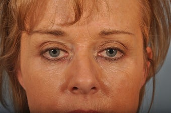 Hetter Peel on lower eyelids. before 857419