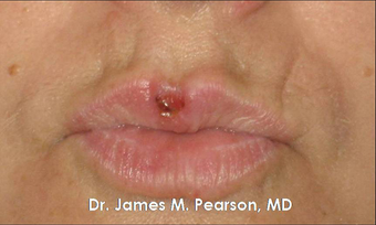Lip Reconstruction 919804