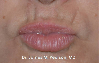 Lip Reconstruction 919804