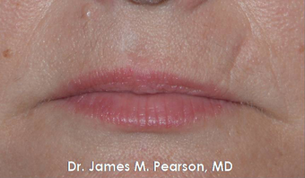 Lip Reconstruction after 919804