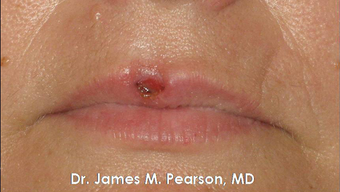 Lip Reconstruction before 919804