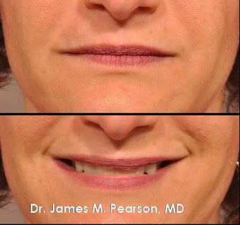 Injectable Filler Treatment after 910409
