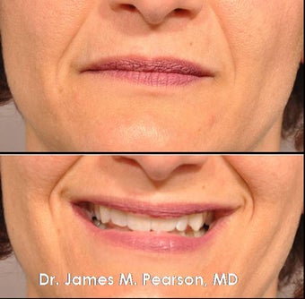 Injectable Filler Treatment before 910409