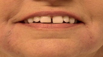 Radiesse before and after for Marionette Lines after 1125249