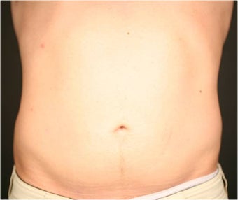 SmartLipo MPX before 686364