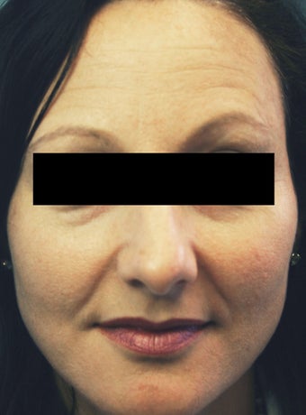 Botox before 1010799