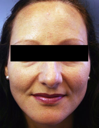 Botox after 1010799