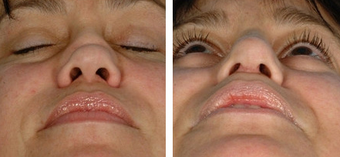Functional Rhinoplasty before 1208302
