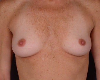 Breast Augmentation before 281418