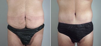 25 year old male with large weight loss had tummy tuck before 720780