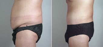25 year old male with large weight loss had tummy tuck after 720780