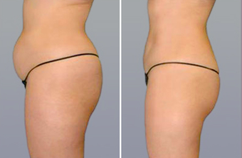 SmartLipo before 996918
