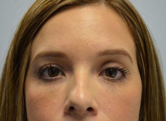 32 Year Old Female Treated for Under Eye Hollows after 1130031