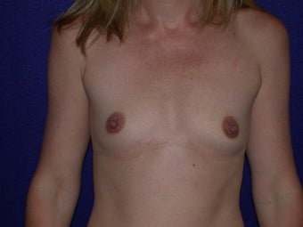 Breast Augmentation before 204618