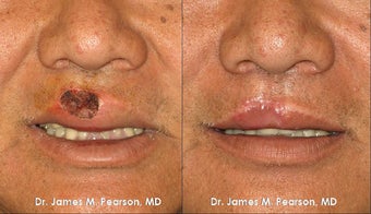 Lip Reconstruction before 919850
